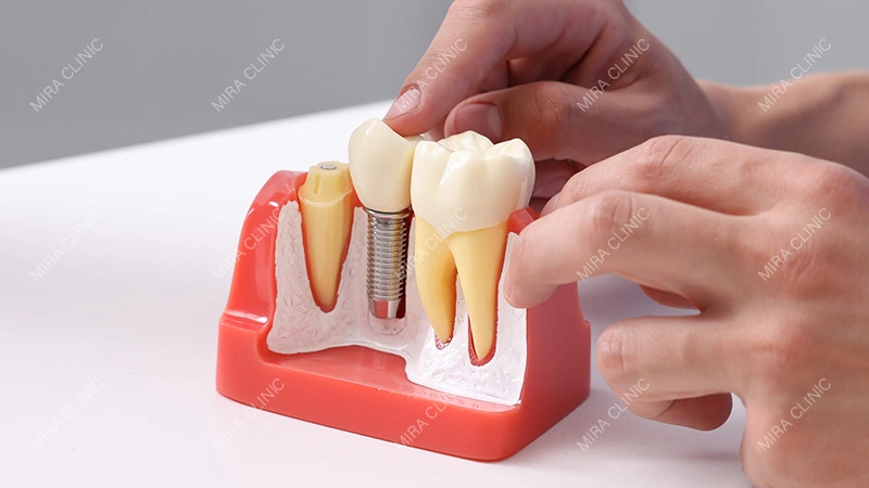 dental implant brand